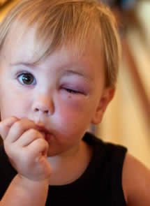 Young Child with Chagas Disease