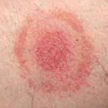 Tick Bite on Arm
