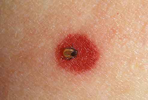Tick Bite and Lyme Disease