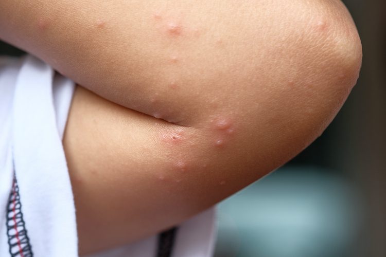 How to Get Rid of Bed Bug Bites on Skin