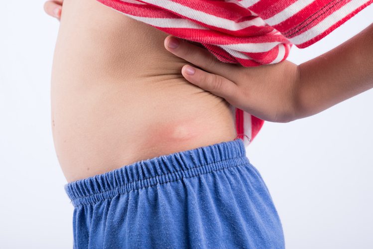 What Is The best Treatment For Bed Bug Bites