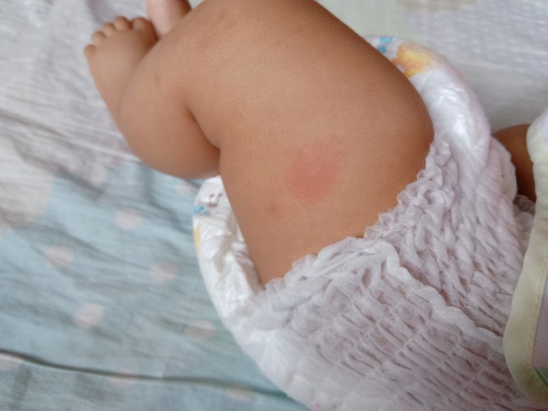 Get Rid of Bed Bug Bites on Babies