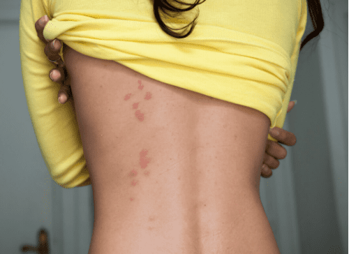 bed bug bites