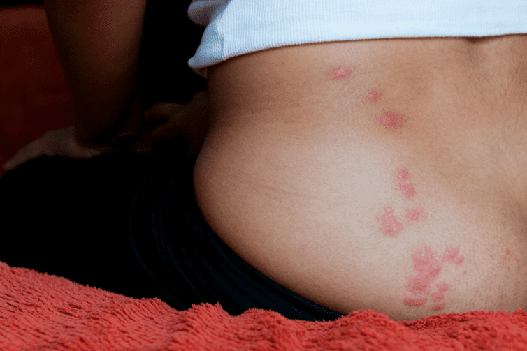 Solutions for Bed Bug Bites