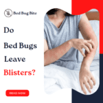 Do Bed Bugs Leave Blisters 
